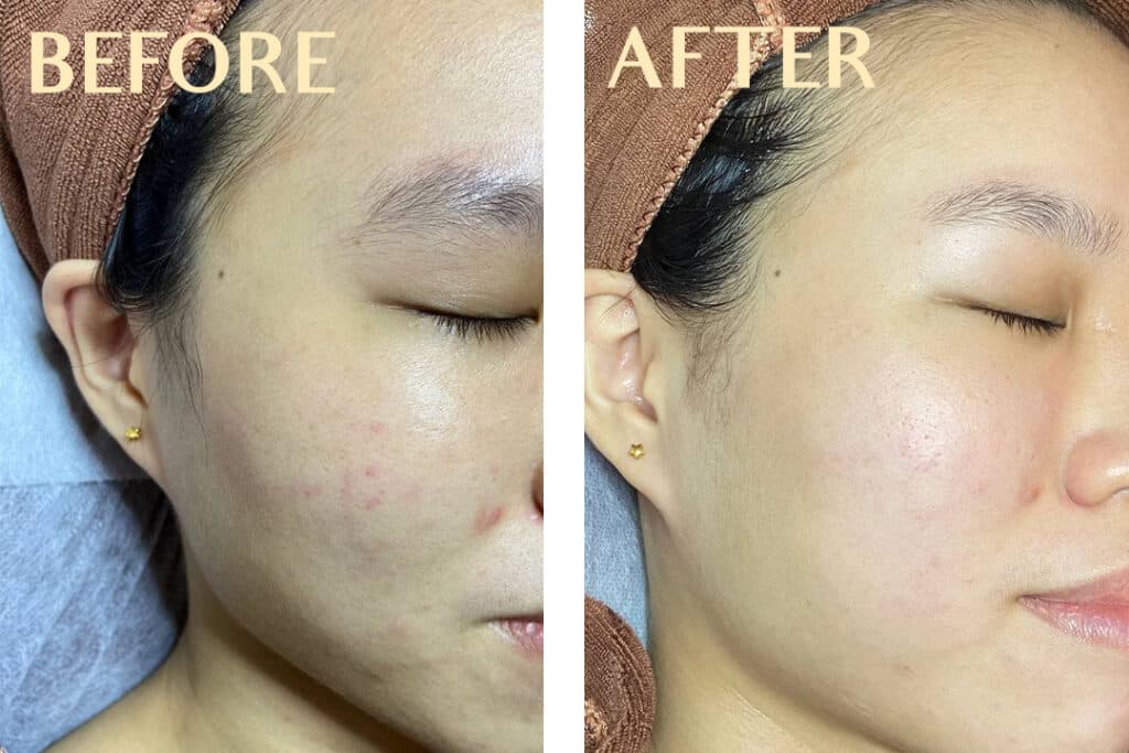 Niacinamide for Pore Perfection