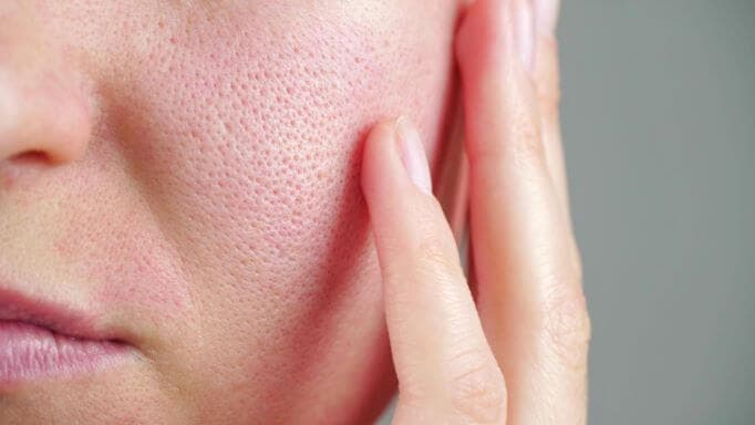 pores